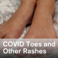 Covid rashes